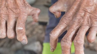 Photo of कुष्ठ रोगियों से दूरी नहीं बनाएं, उसका इलाज करवाएं