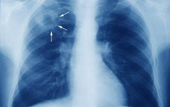 Photo of टीबी के लक्षण दिखे तो संकोच नहीं करें, सरकारी अस्पताल में जांच कराएं