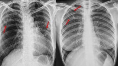 Photo of अब नोटिफाई होते ही टीबी मरीज के खाते में पहुंचेगी पोषण राशि की पहली क़िस्त